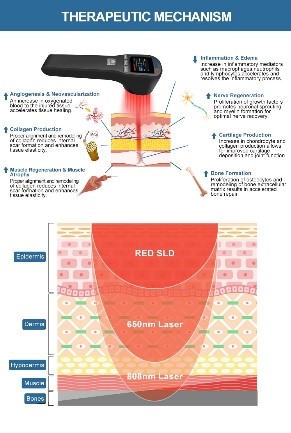 IMAGEN-LASERTERAPIA-2
